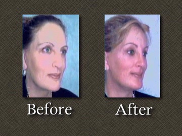 Before after plastic surgery photo of Linda-Tripp in 2008.