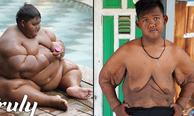 How Did the World's Fattest Kid Lose Weight? Here's What You Should Know About Arya Permana's Incredible Weight Loss