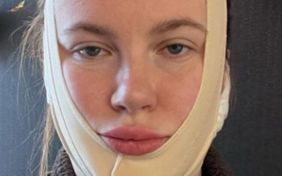 Ireland Baldwin Gets a 'Mini FaceLift' - All details Here